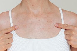 scar removal treatment